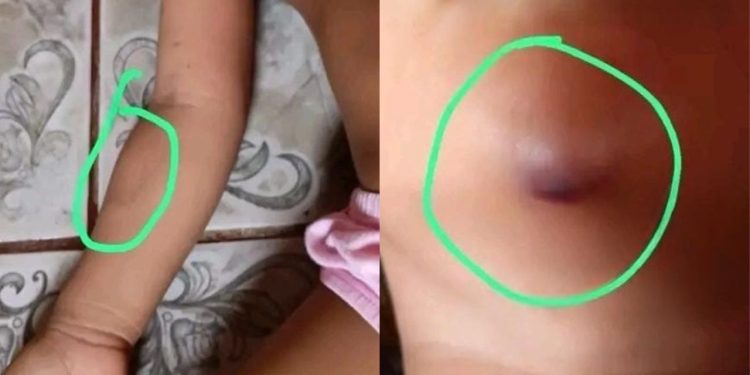 Família denuncia que menina de 3 anos voltou de creche com marcas de mordidas no Amazonas