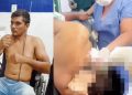 Vídeo forte: médicos retiram arpão de pesca da cabeça de pescador no SPA