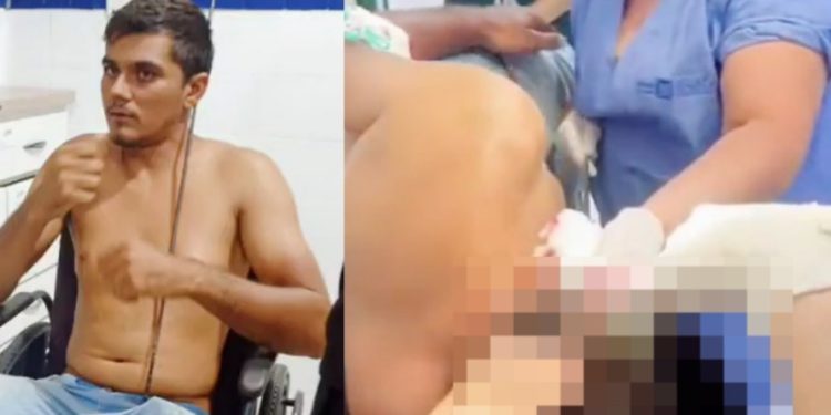 Vídeo forte: médicos retiram arpão de pesca da cabeça de pescador no SPA