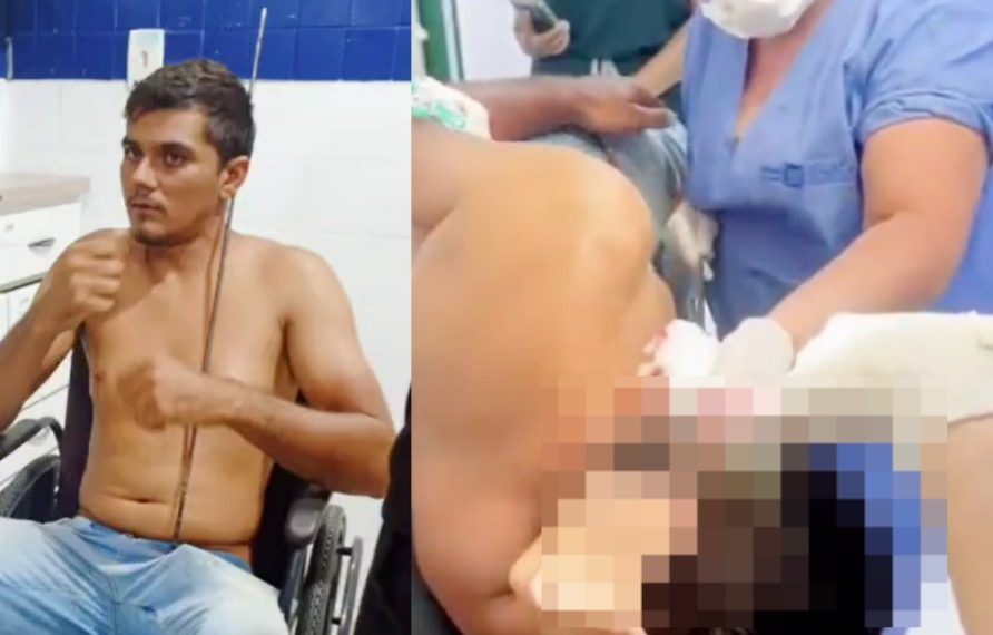 Vídeo forte: médicos retiram arpão de pesca da cabeça de pescador no SPA